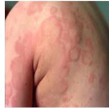 réactions allergiques