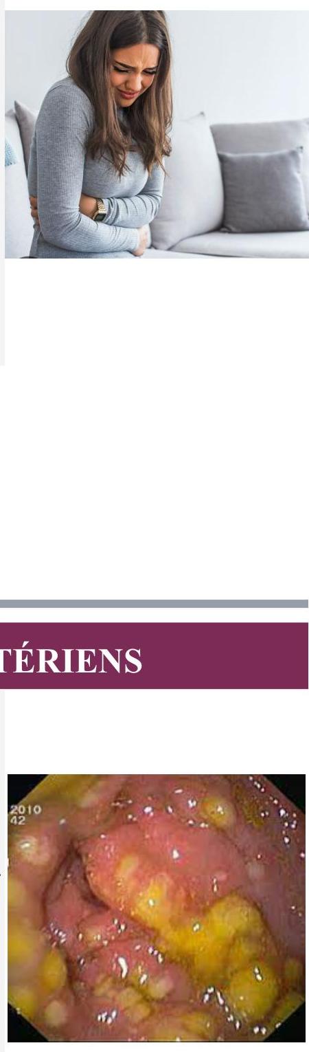 colite pseudomembraneuse